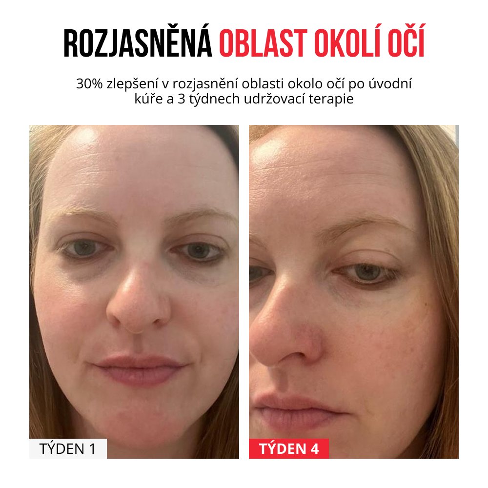 Samorozpustné mikrojehličkové náplasti