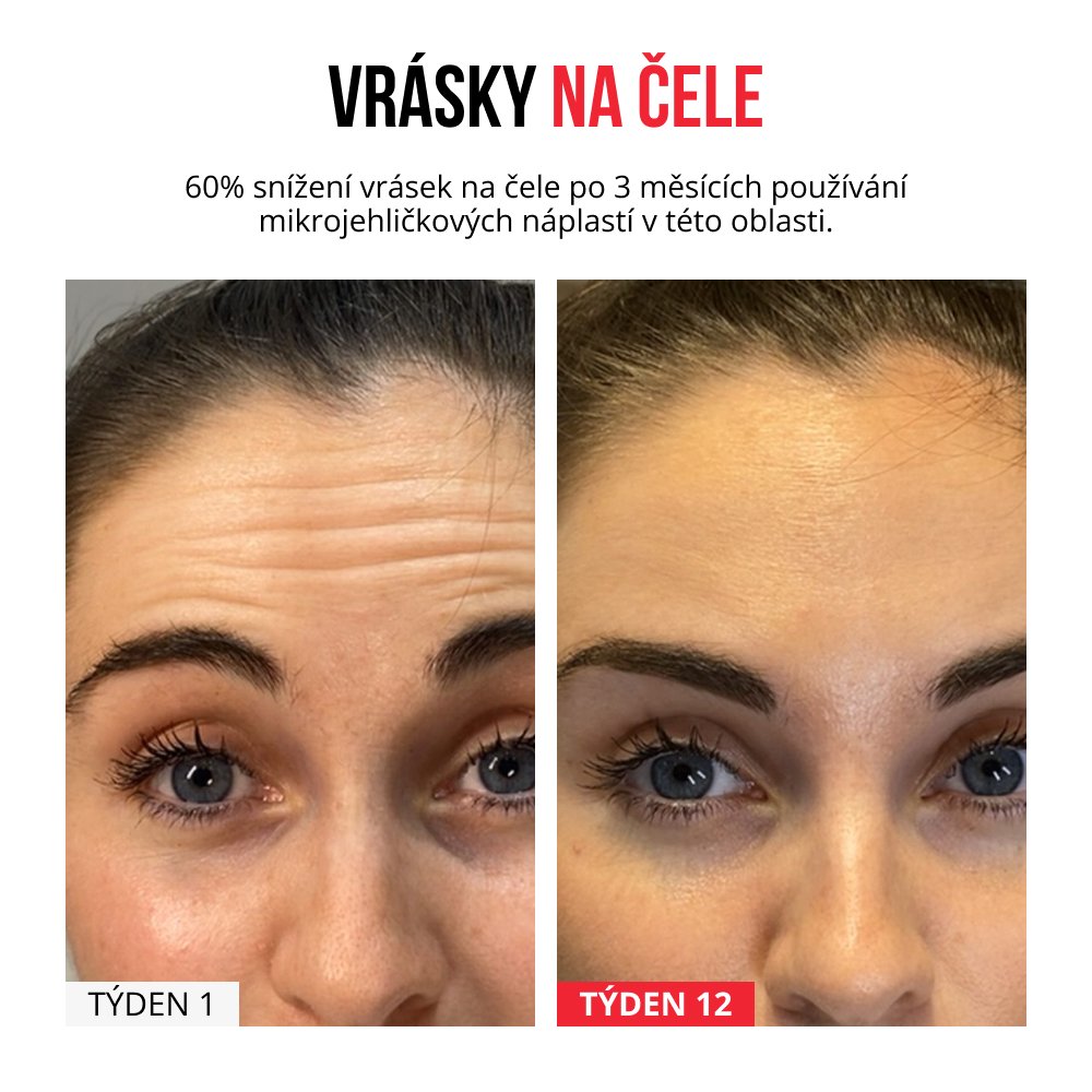 Samorozpustné mikrojehličkové náplasti